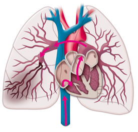Plicní embolie