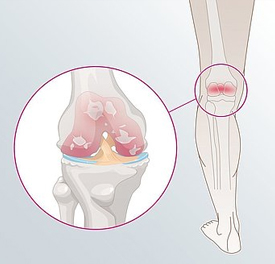 Osteoartróza kolene